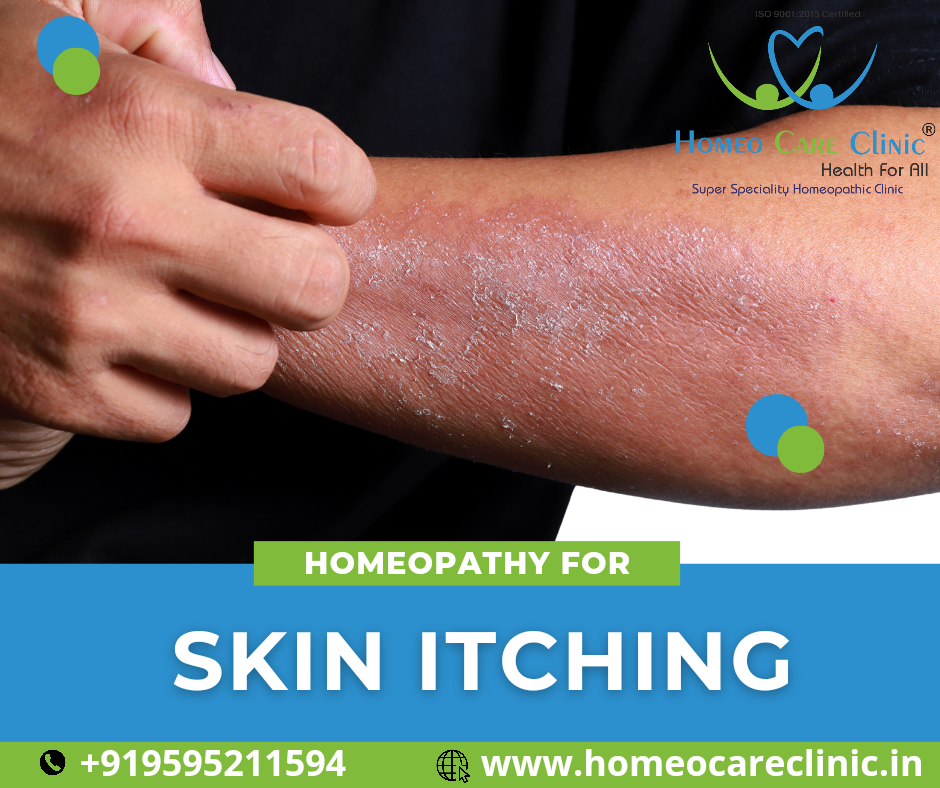 Homeopathic remedies for skin itching