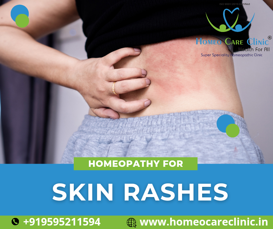 homeopathic treatment for skin rashes