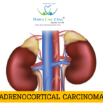 Homeopathic remedies for Adrenocortical Carcinoma