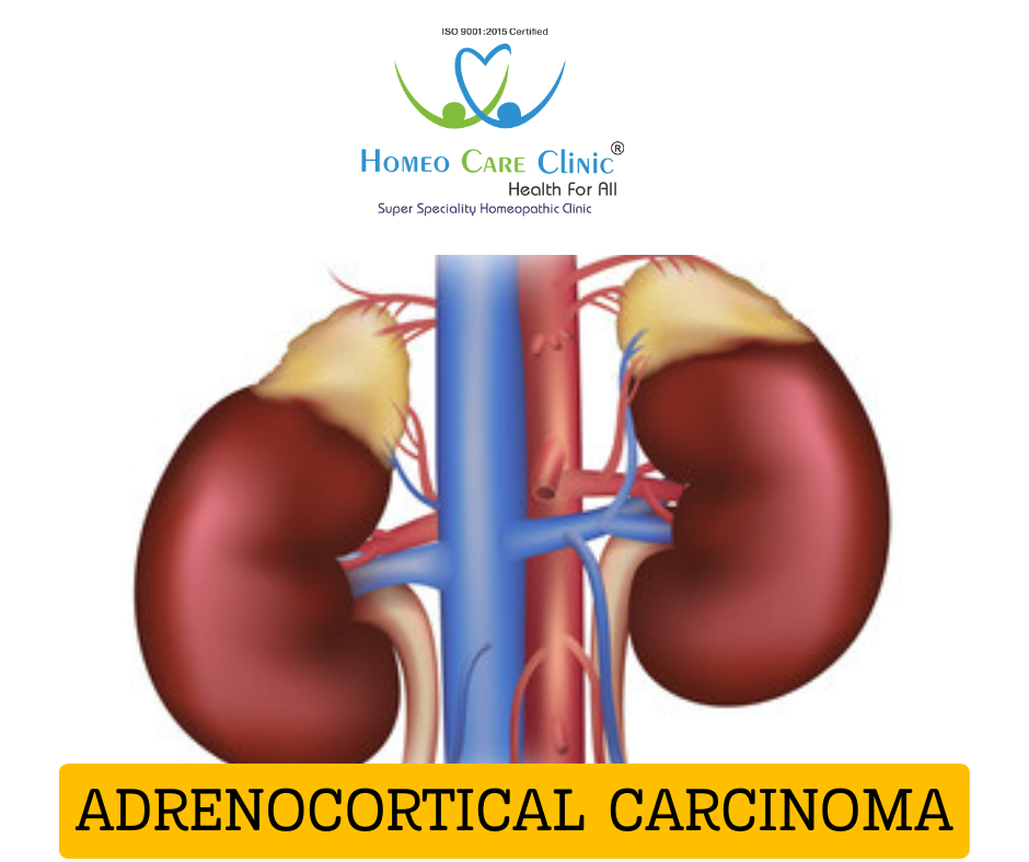 Homeopathic remedies for Adrenocortical Carcinoma