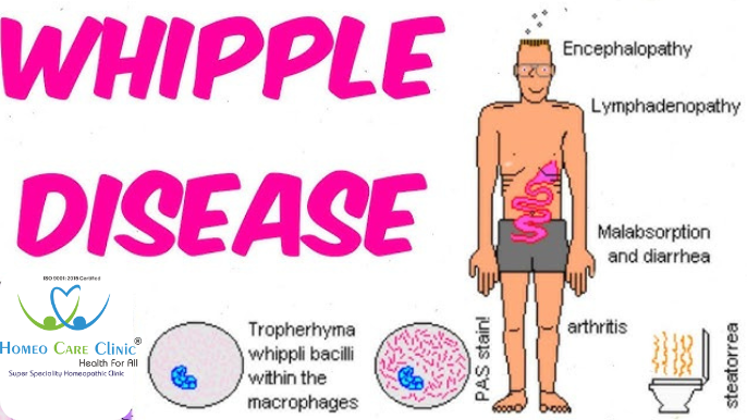 Whipple disease symptoms