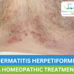 homeopathy remedies for Dermatitis Herpetiformis.