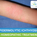 symptoms Epidermolytic Hyperkeratosis