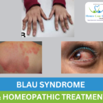 Blau Syndrome treatment