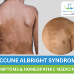 McCune-Albright syndrome treatment