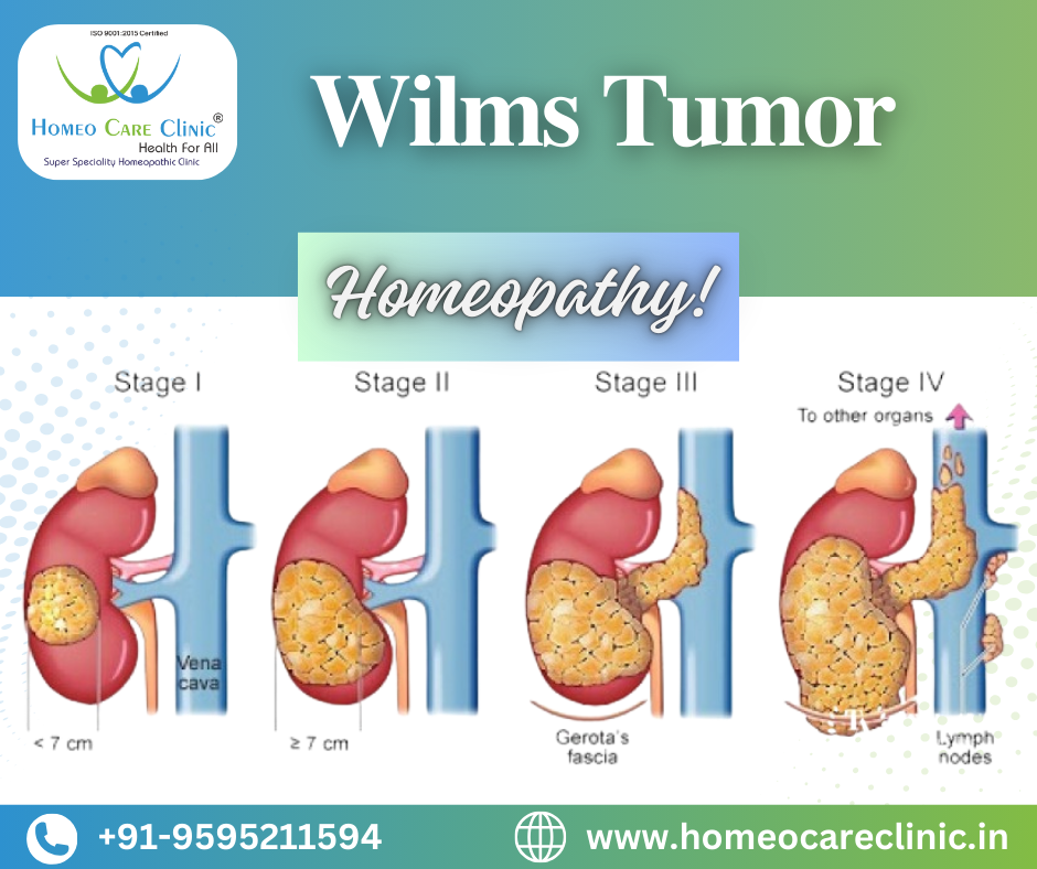 Wilms tumor support for children with homeopathy care