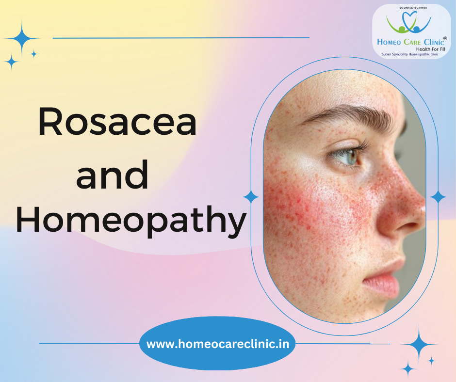 "Holistic homeopathic treatment for rosacea for lasting relief"