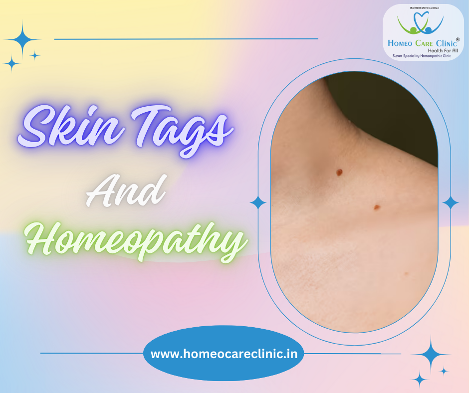 Homeopathic natural treatment for skin tags without surgery