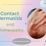 Contact Dermatitis Homeopathy Treatment