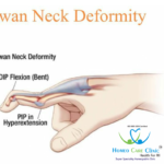 symptoms of swan neck deformity