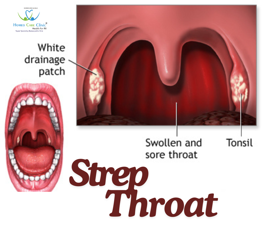 remedies for treating strep throat symptoms.