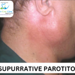 Homeopathic remedies for suppurative parotitis