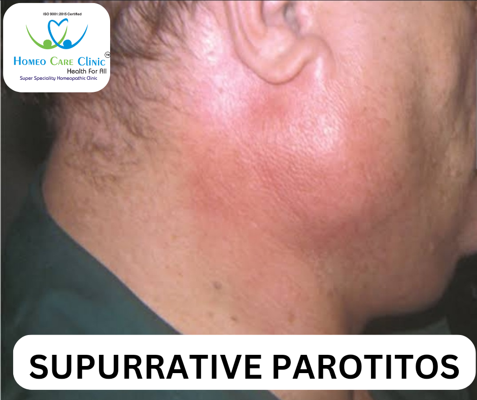 Homeopathic remedies for suppurative parotitis