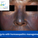 Homeopathic Remedies for Argyria