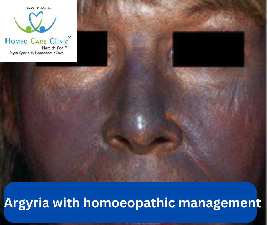 Homeopathic Remedies for Argyria