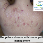 natural solutions for Morgellons disease