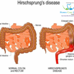 Hirschsprung disease treatment