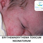 Erythema Toxicum Neonatorum symptoms