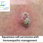 Cell Carcinoma homeopathy remedies