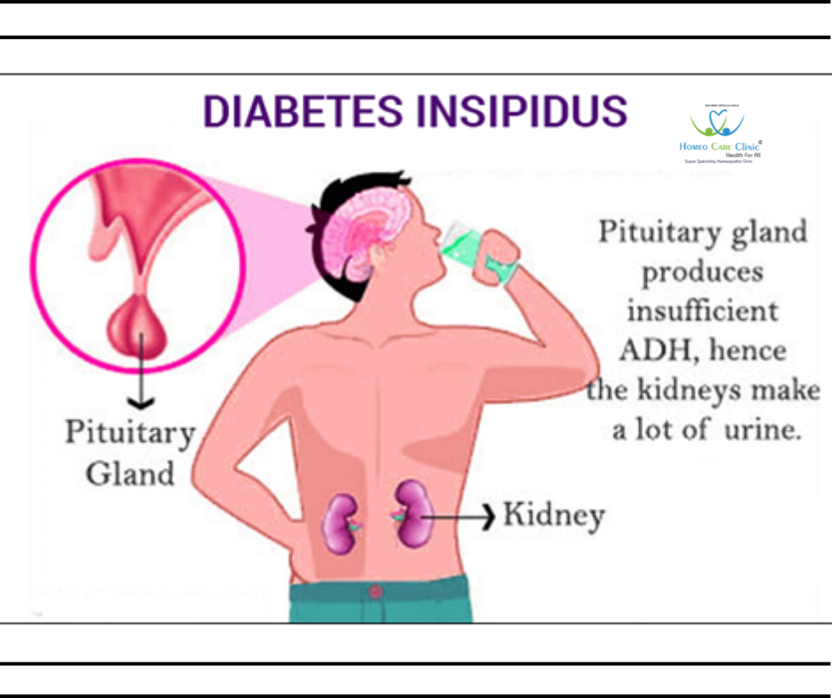 Diabetes Insipidus 