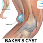 Baker’s Cyst symptoms