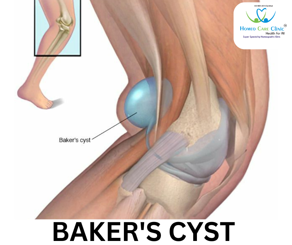 Baker’s Cyst symptoms