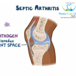 Homeopathic medicines for Septic Arthritis