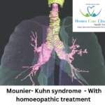 Understanding Mounier-Kuhn Syndrome: Symptoms and Treatment