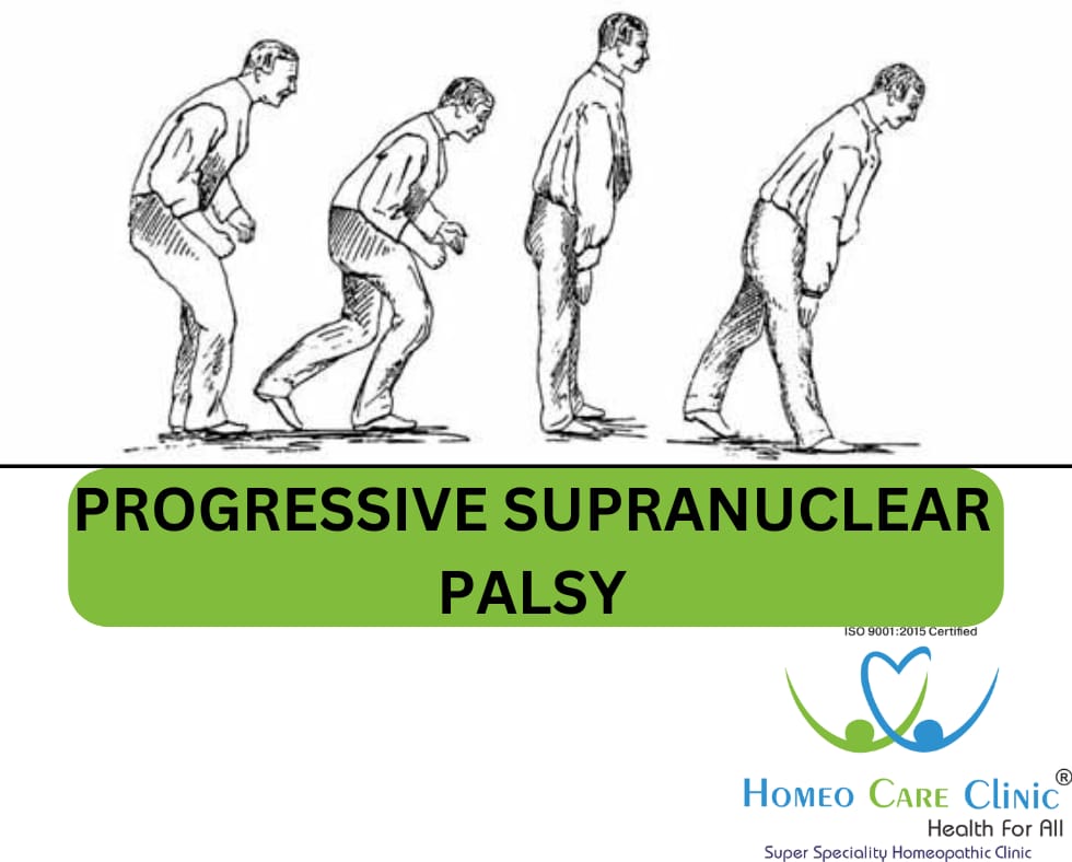 Supranuclear Palsy treatment