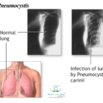 Pneumocystis symptoms