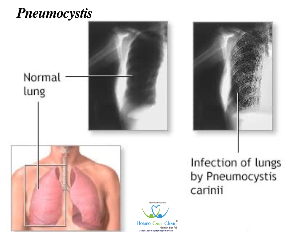 Pneumocystis symptoms