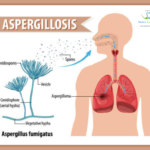 homeopathic treatment for Aspergillosis.