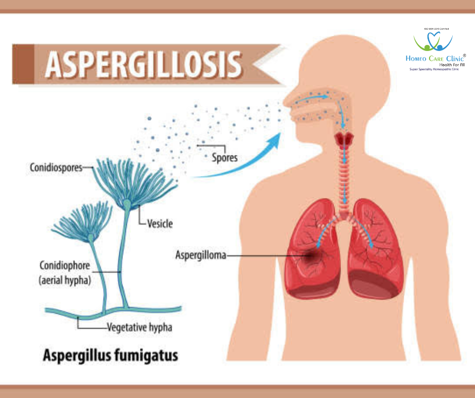 homeopathic treatment for Aspergillosis.