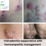 Hidradenitis Suppurativa Symptoms