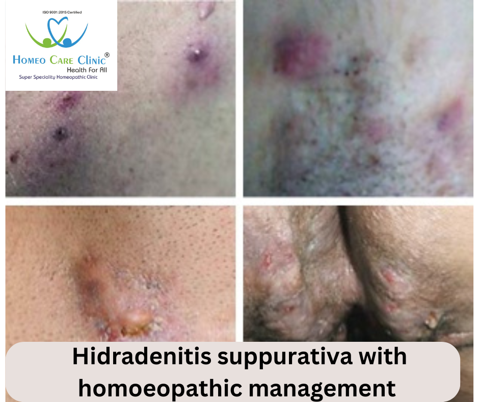 Hidradenitis Suppurativa Symptoms