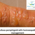 Medical treatment options for Bullous Pemphigoid