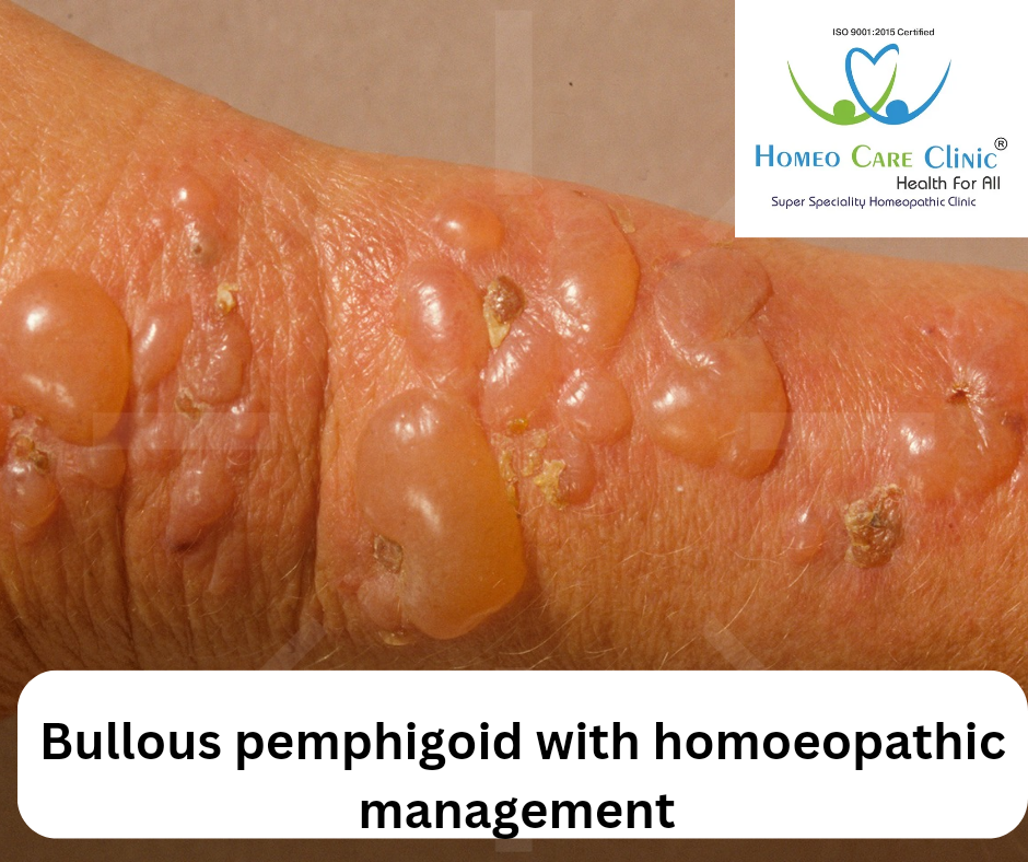 Medical treatment options for Bullous Pemphigoid