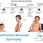 Duchenne Muscular Dystrophy and its effects