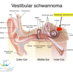 Vestibular Schwannoma treatment with homeopathy for balance and hearing improvement.