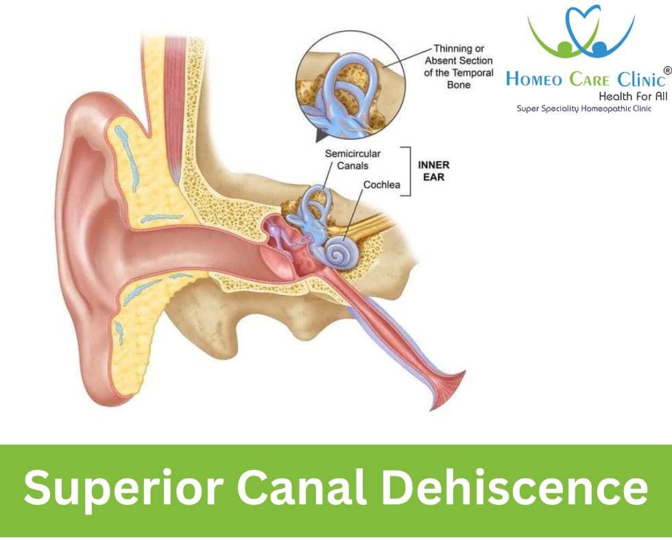 Superior Canal Dehiscence Syndrome on the ear