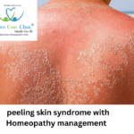 Peeling Skin Syndrome (PSS) symptoms