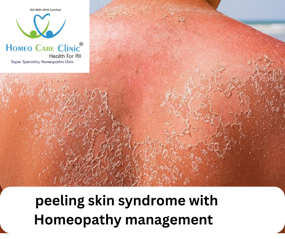 Peeling Skin Syndrome (PSS) symptoms