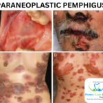 Paraneoplastic Pemphigus symptoms