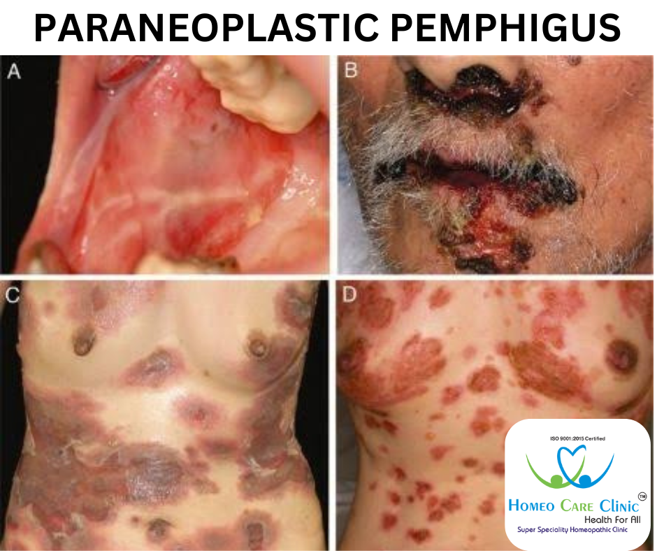 Paraneoplastic Pemphigus symptoms