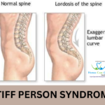 Stiff Person Syndrome symptoms