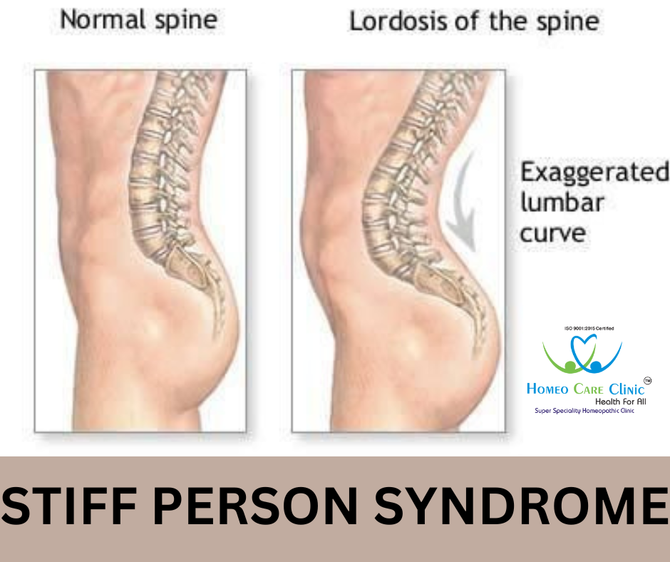 Stiff Person Syndrome symptoms