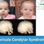 causes of Auriculo-Condylary Syndrome