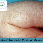 Transient Neonatal Pustular Melanosis symptoms