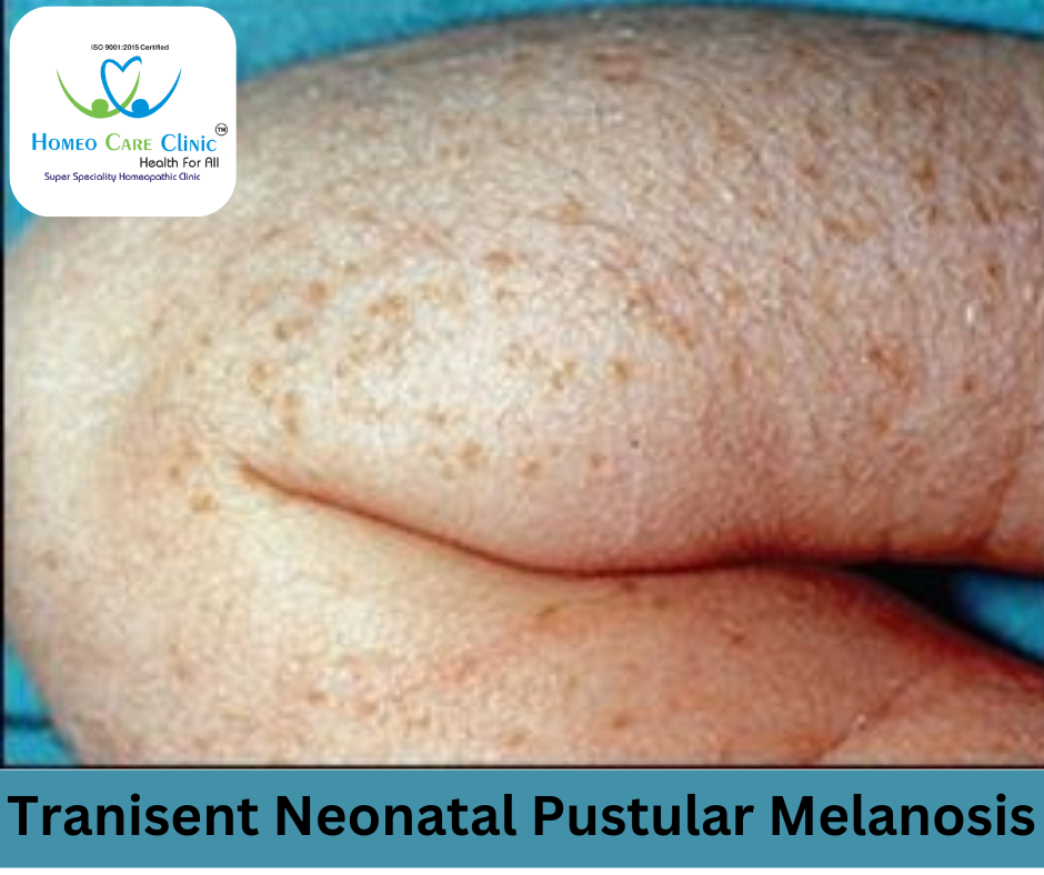 Transient Neonatal Pustular Melanosis symptoms