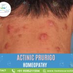 homeopathy treatment for Actinic Prurigo